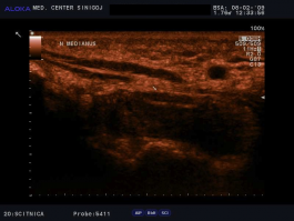 Ultrazvok karpalnega kanala - nervus medianus prečno, normalen izvid
